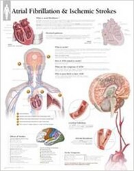 Atrial Fib & Ischemic Strokes Wall Chart Atrial Fib & Ischemic Strokes Wall Chart